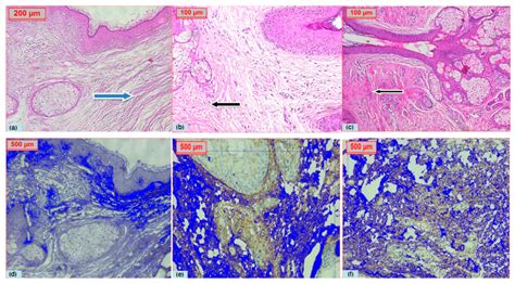 Fractional Ablative Carbon Dioxide Laser versus Fractional Non-Ablative ...