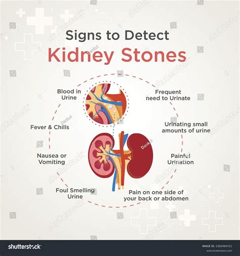 Kidney Stones Kidney Health Signs Medical Stock Vector (Royalty Free) 2382494721 | Shutterstock