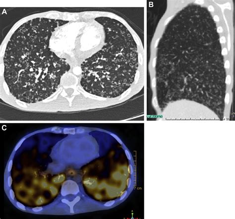 Cavitary Lung Diseases - CHEST