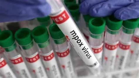 Mpox case reported in Malappuram is from new variant; can cause severe ...