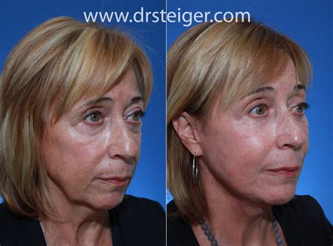 Eyelid Surgery Before And After Photos