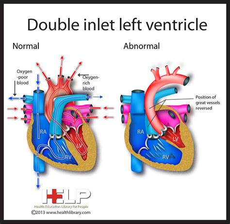 28 Double Inlet Left Ventricle ideas | heart defect, congenital heart, inlet