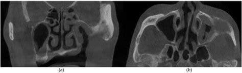 The Role of Cone Beam Computed Tomography (CBCT) in the Diagnosis and ...