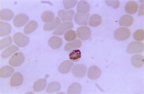 Plasmodium Blood Smear at Michael Nipper blog