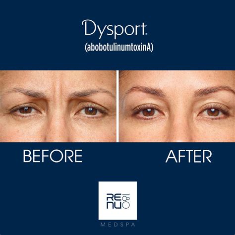 Dysport CT | #1 Dysport Treatment in Connecticut | Re:nu 180