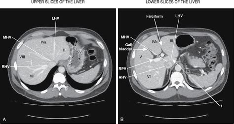 Segment-oriented anatomic liver resections: Indications and outcomes - Clinical Tree
