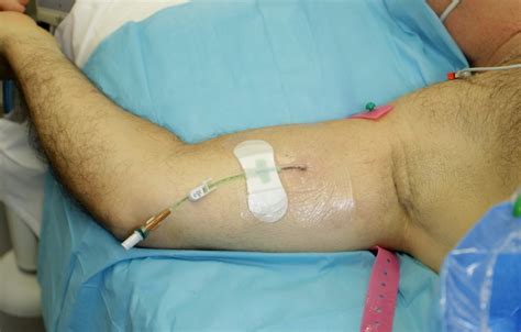 Catheter Site Thrombosis at Isla Lascelles blog