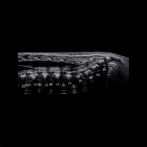 Medical Term For Sacral Dimple at Julian Lentini blog