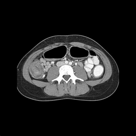 Pediatric Infectious Colitis | Pediatric Radiology Reference Article | Pediatric Imaging ...