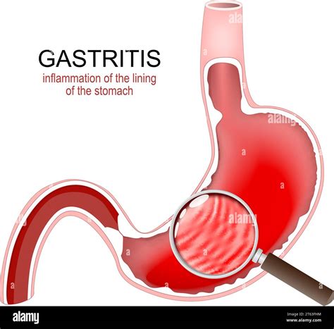 Gastritis. Stomach Inflammation. Gastrointestinal Disorders. Cross section of a human stomach ...