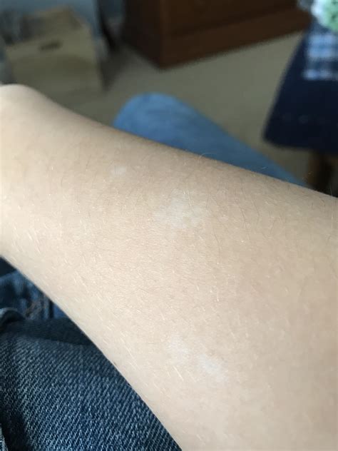 What are these white spots on my arm? : r/medical_advice