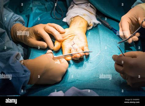 Bildergebnis für dupuytren's surgery pictures