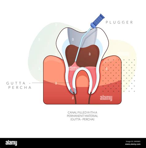 Infected Teeth - Root Canal Treatment - Stock Illustration as EPS 10 File Stock Vector Image ...