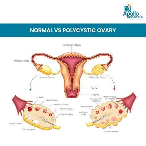 PCOD - Causes, Symptoms, Diagnosis, Treatment, Complications.