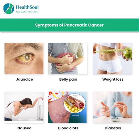 Symptoms Of Stage 4 Pancreatic Cancer
