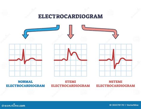 Electrocardiogram STEMI and NSTEMI Abnormal Heart Rate Outline Diagram ...