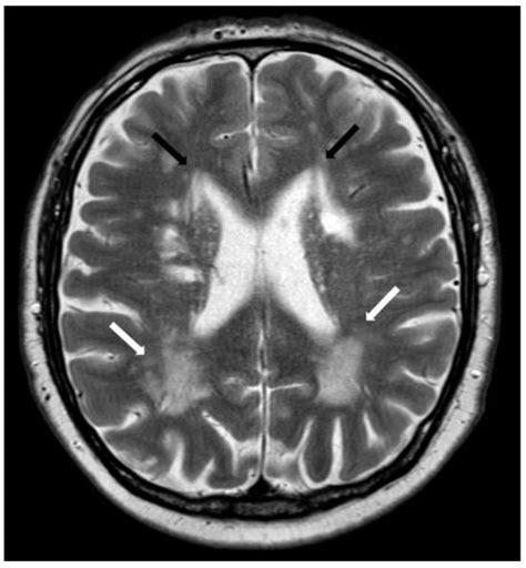 Neuroradiological Findings in Cerebral Amyloid Angiopathy with a ...