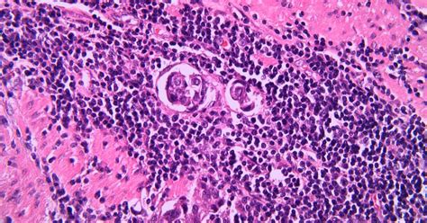 Padcev Positioned For Urothelial Cancer Expansion