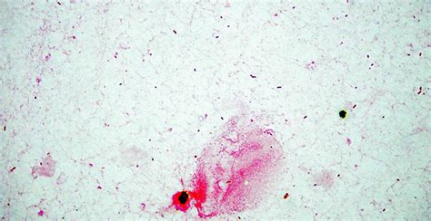 Haemophilus Ducreyi Gram Stain