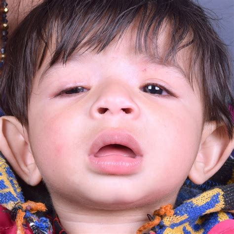 Apex Eye & Dental Hospital || Pediatric Ophthalmology