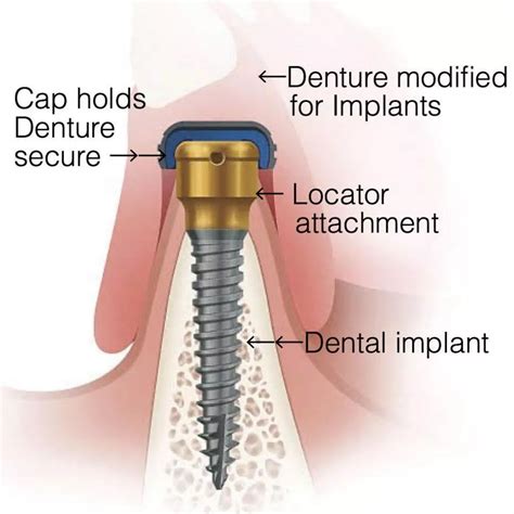 Overdentures | Dental Implant & Periodontal Surgeons