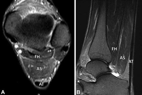 Soleus Leg Pain at Deidra Mckoy blog