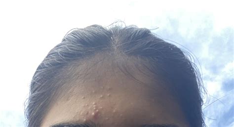 closed comedones help!! i’ve tried salicylic acid and differin but nothing helping : r/Skincare ...