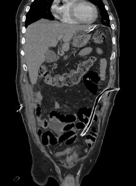 Bildergebnis für ruptured abscess on colon