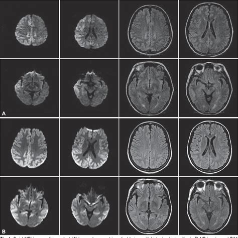 Gertsmann-straussler-scheinker Syndrome - Captions Profile