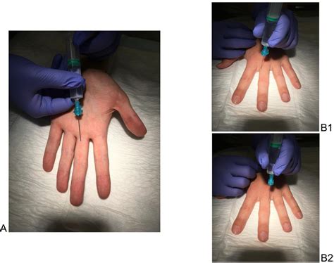 Regional anaesthesia on the finger: Traditional dorsal digital nerve ...