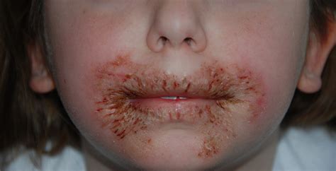 Face Skin Rash Allergy at Chelsea Elyard blog