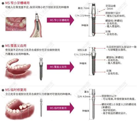韩国奥齿泰MS Implant种植体,适合于窄小牙槽嵴及覆盖义齿使用 - 牙科治疗 - 开立特口腔