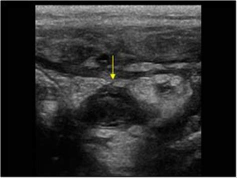 Image result for Perforated Appendix