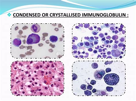 Plasma Cell Dyscrasias.pptx
