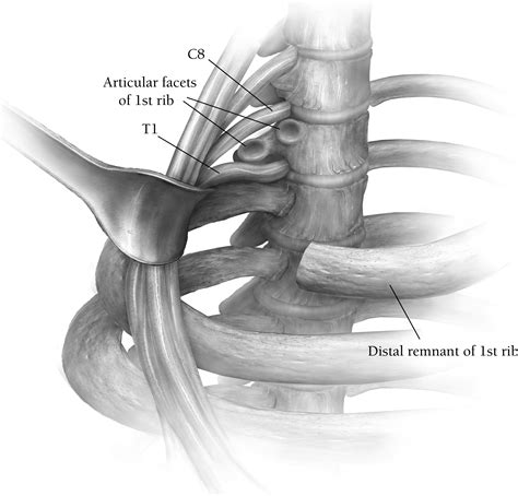 Supraclavicular Approach to First Rib Resection for Thoracic Outlet Syndrome - Operative ...