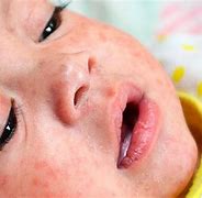 measles 的图像结果