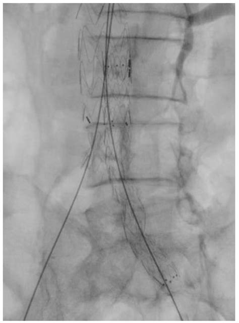 Contralateral Snare Cannulation vs. Retrograde Gate Cannulation during ...