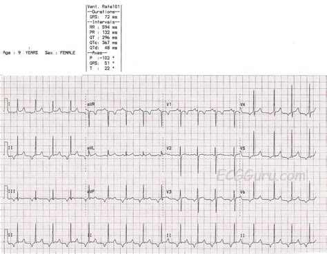 Inverted P waves | ECG Guru - Instructor Resources