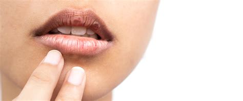 Dry Mouth Syndrome | Symptoms, Causes & Treatments