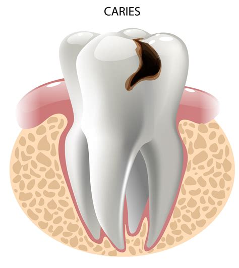 Caries Dentales Tipos _ Los 5 tipos de radiografías dentales que ...