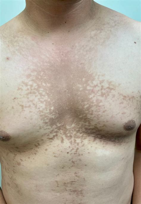 Dermatologic Look-Alikes: Scaly Hyperpigmented Papules on Trunk ...