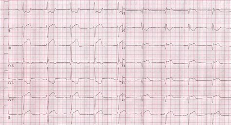 Inferior myocardial infarction - wikidoc