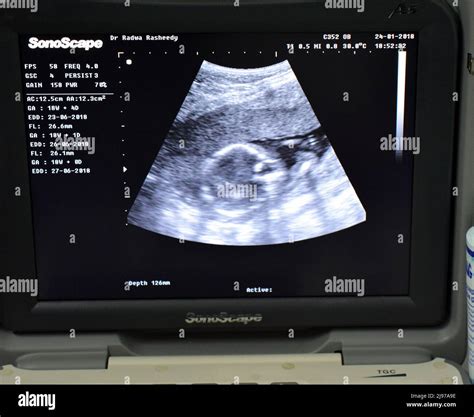 Ultrasound showing the fetus head hi-res stock photography and images - Alamy
