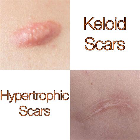 Impetigo scars causes and how to treat the scarring – Artofit