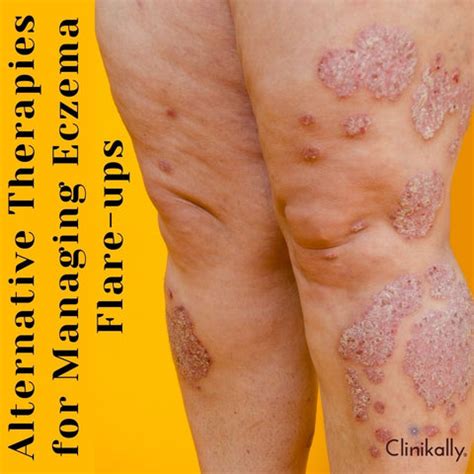 Eczema Flare-ups: Treatment, Causes and Home Remedies | Clinikally