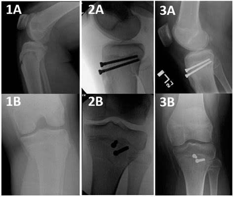 Type 4 Tibial Tuberosity Avulsion Fractures: Surgical Treatment Early Outcomes and a ...