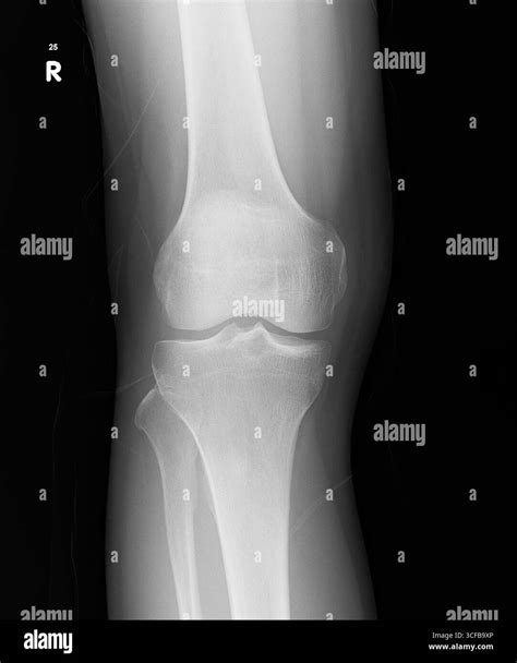 Knee joint dislocation Black and White Stock Photos & Images - Alamy