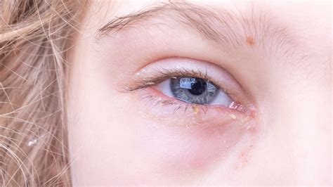Eye Discharge: Causes, Types and Treatment