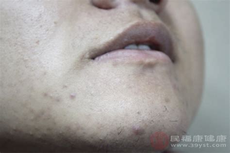 最近两侧脸颊靠近嘴角的地方的痘痘消了又长，长了又消，消了又长。是什么原因呢？谢绝复制粘贴。_百度知道