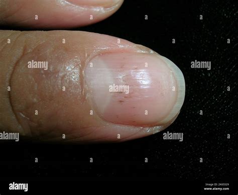 Pitted nail due to severe atopic dermatitis Stock Photo - Alamy